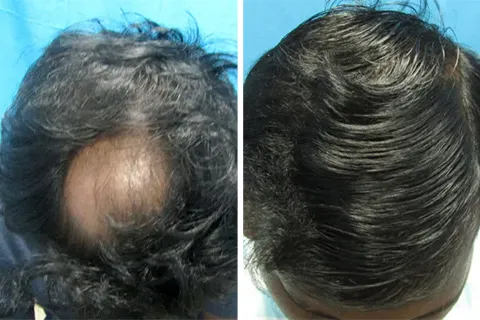 Hair rejuvation therapy before photo in VCare